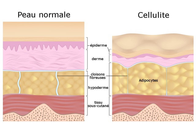 Schema Cellulite